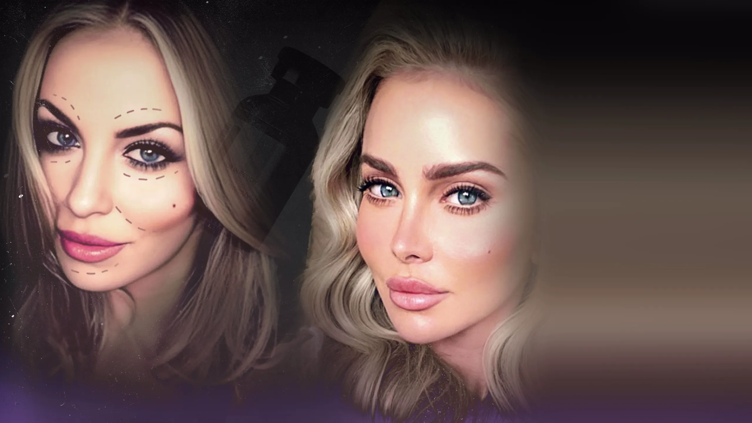 ‪IMPACT x Nightline: Facelift: After Fillers?‬