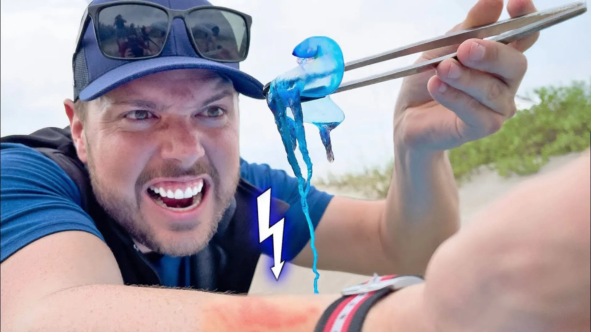 thumbnail - S1:E13 Stung by a Man O' War Jellyfish!
