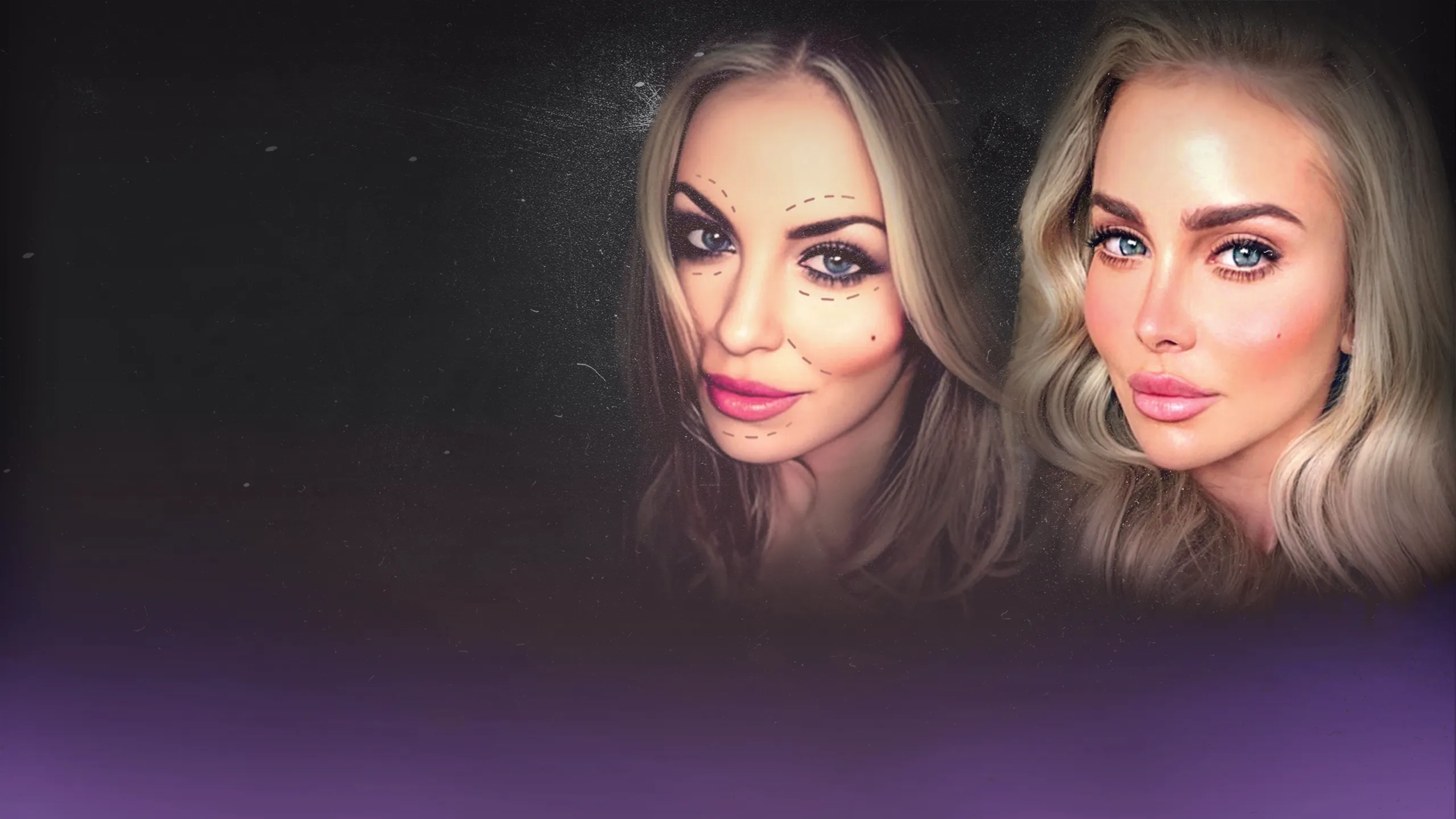 IMPACT x Nightline: Facelift: After Fillers?